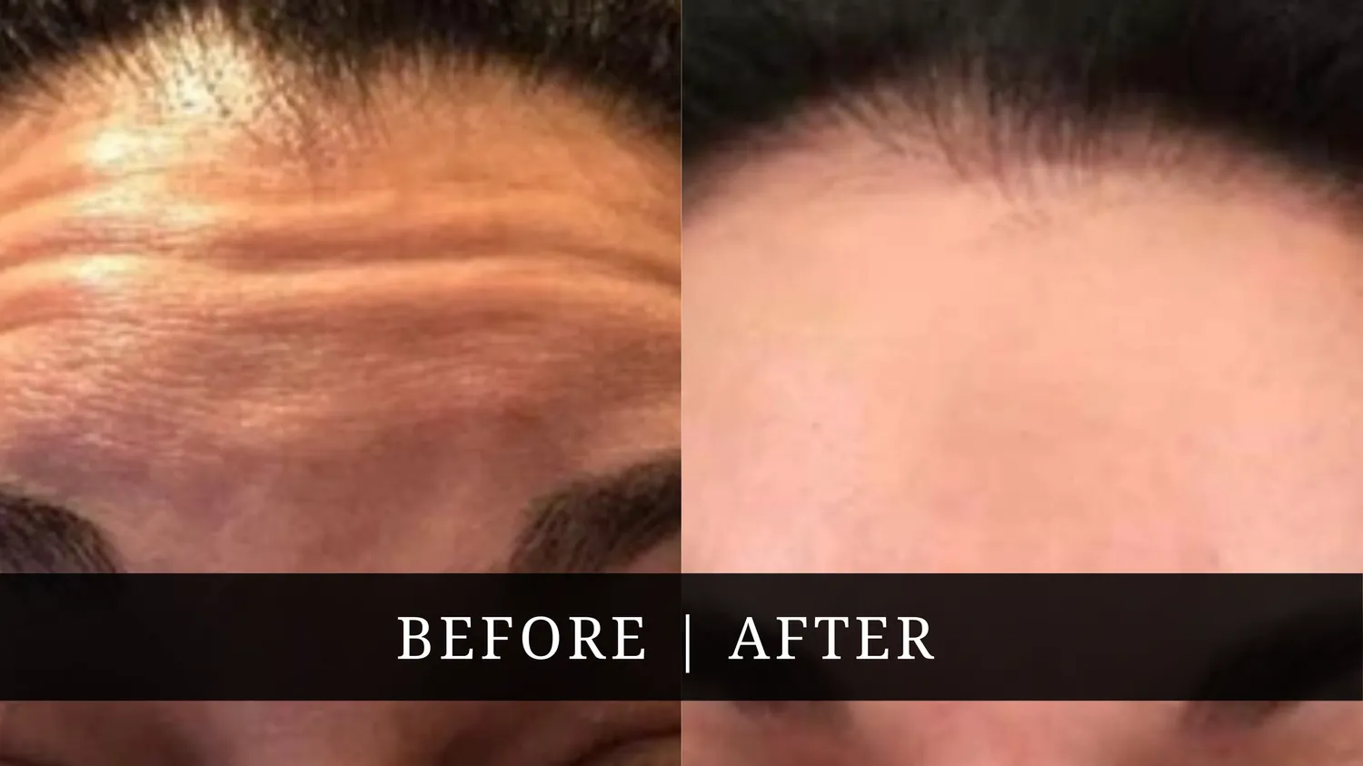 Facelift Before After