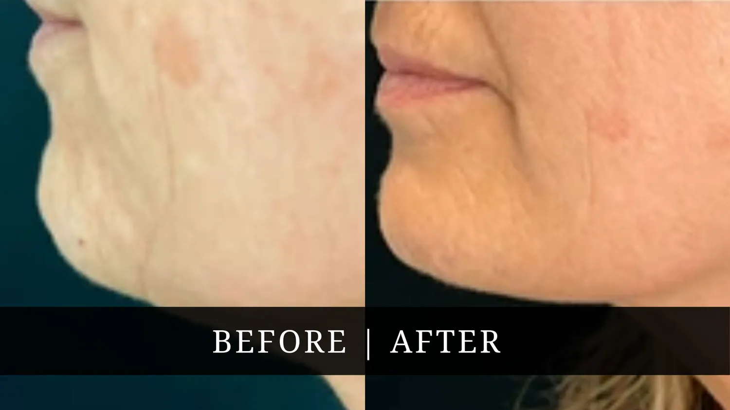 Facelift Before After
