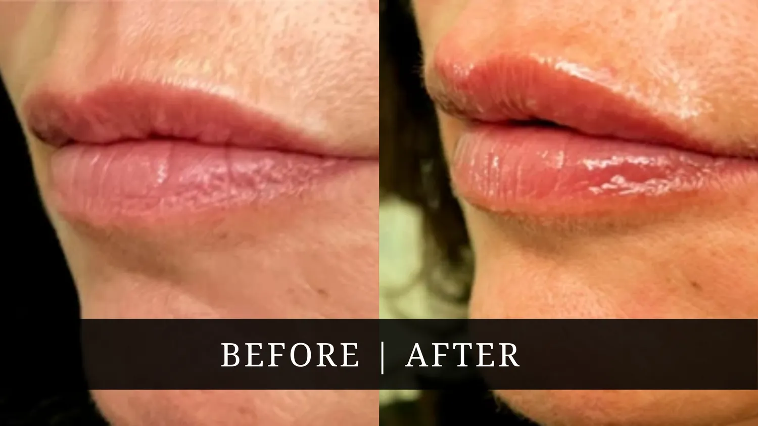 Facelift Before After
