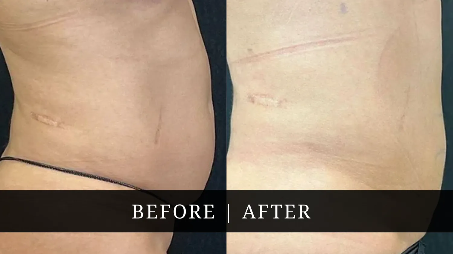 Liposuction