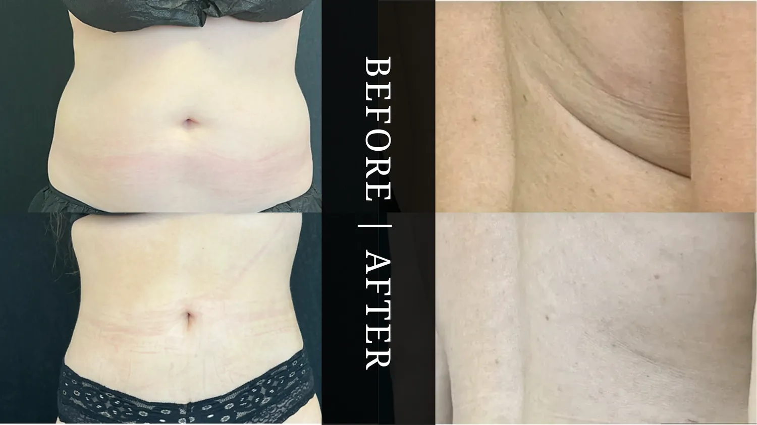Liposuction