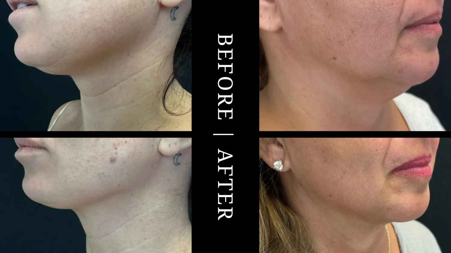 LIPOCONTOURING
