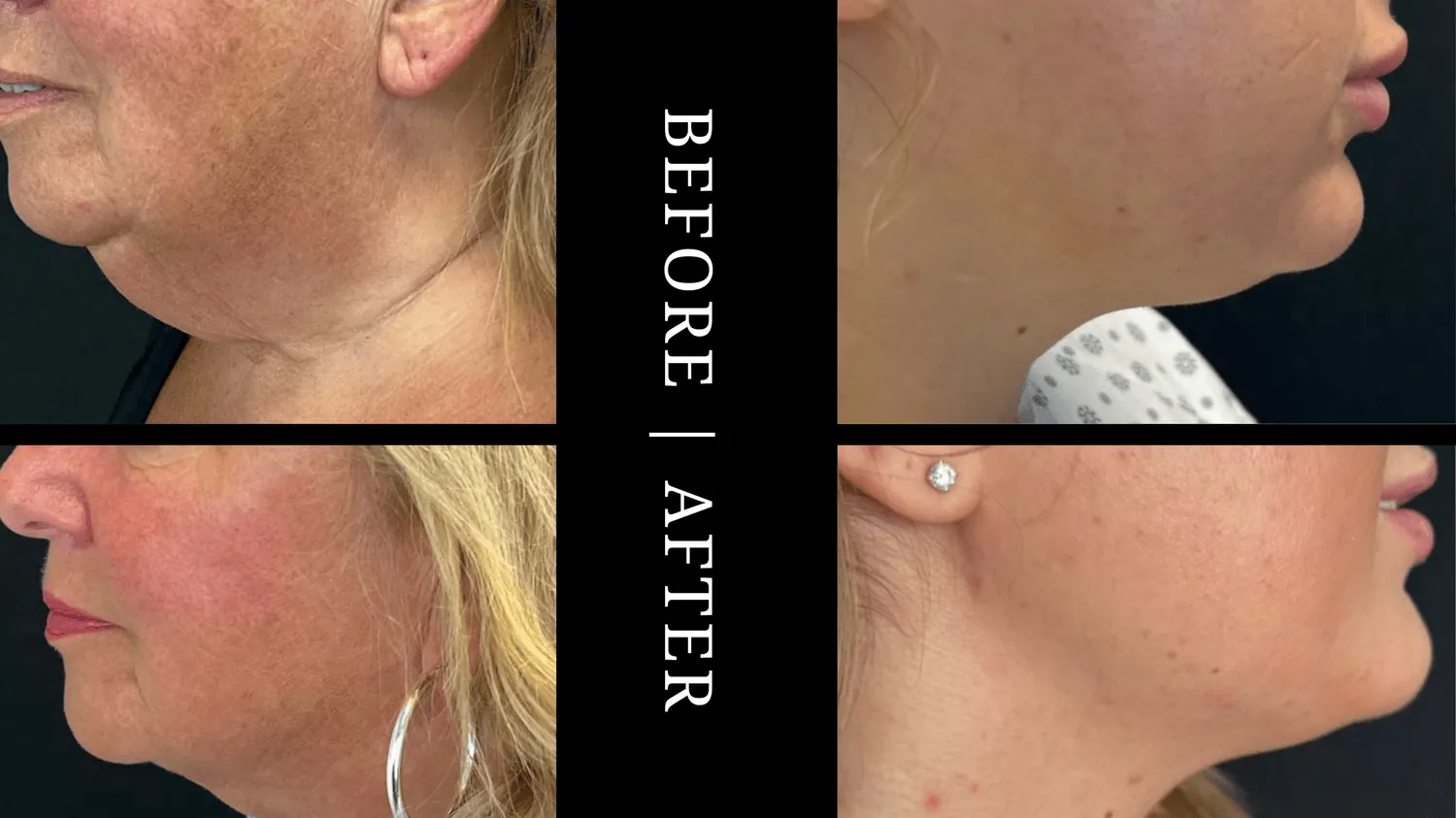 LIPOCONTOURING
