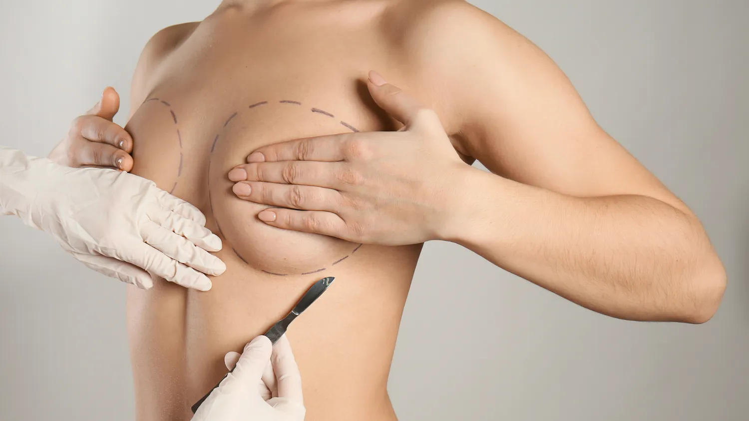 Breast Lift