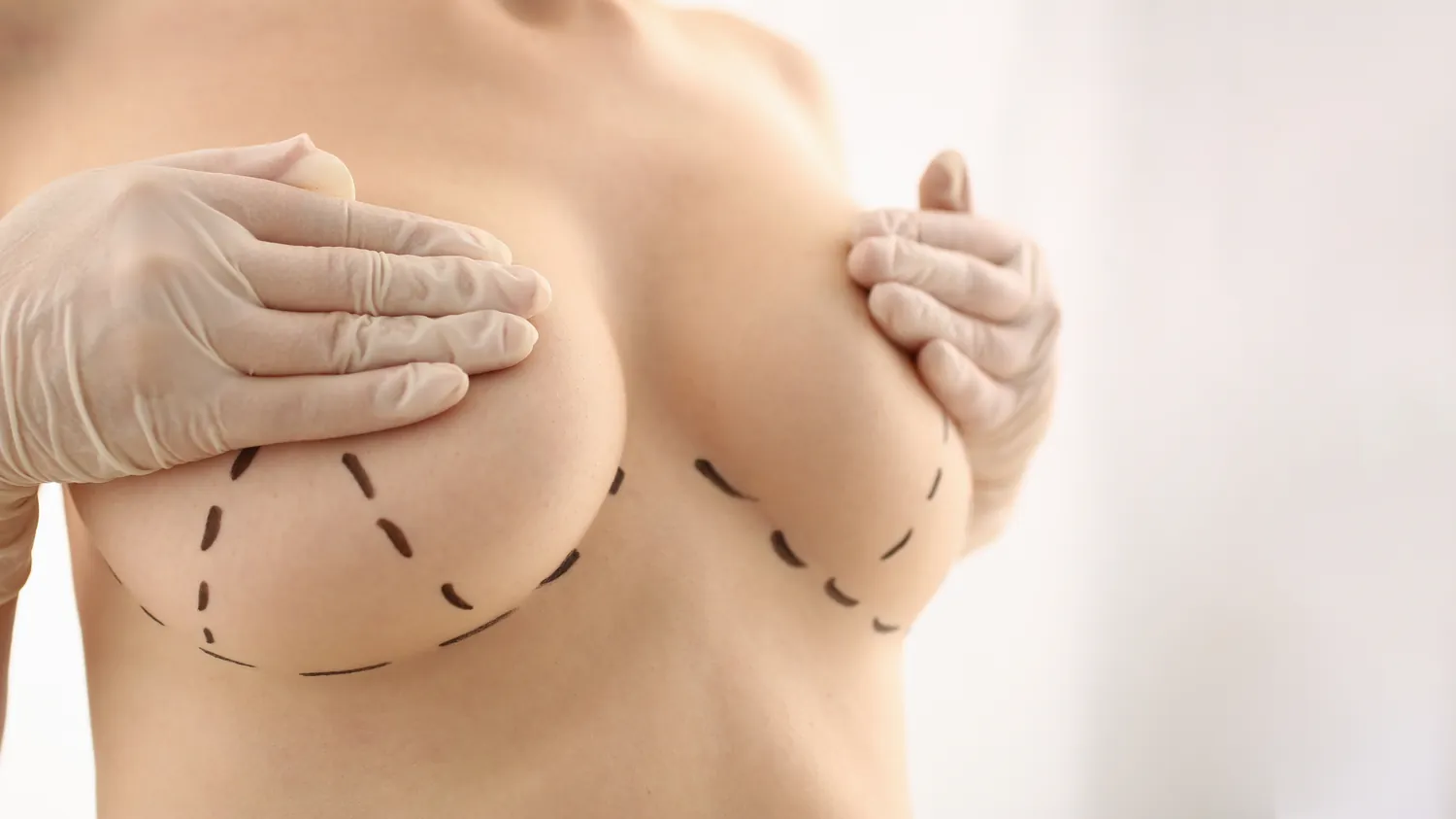 Breast Lift