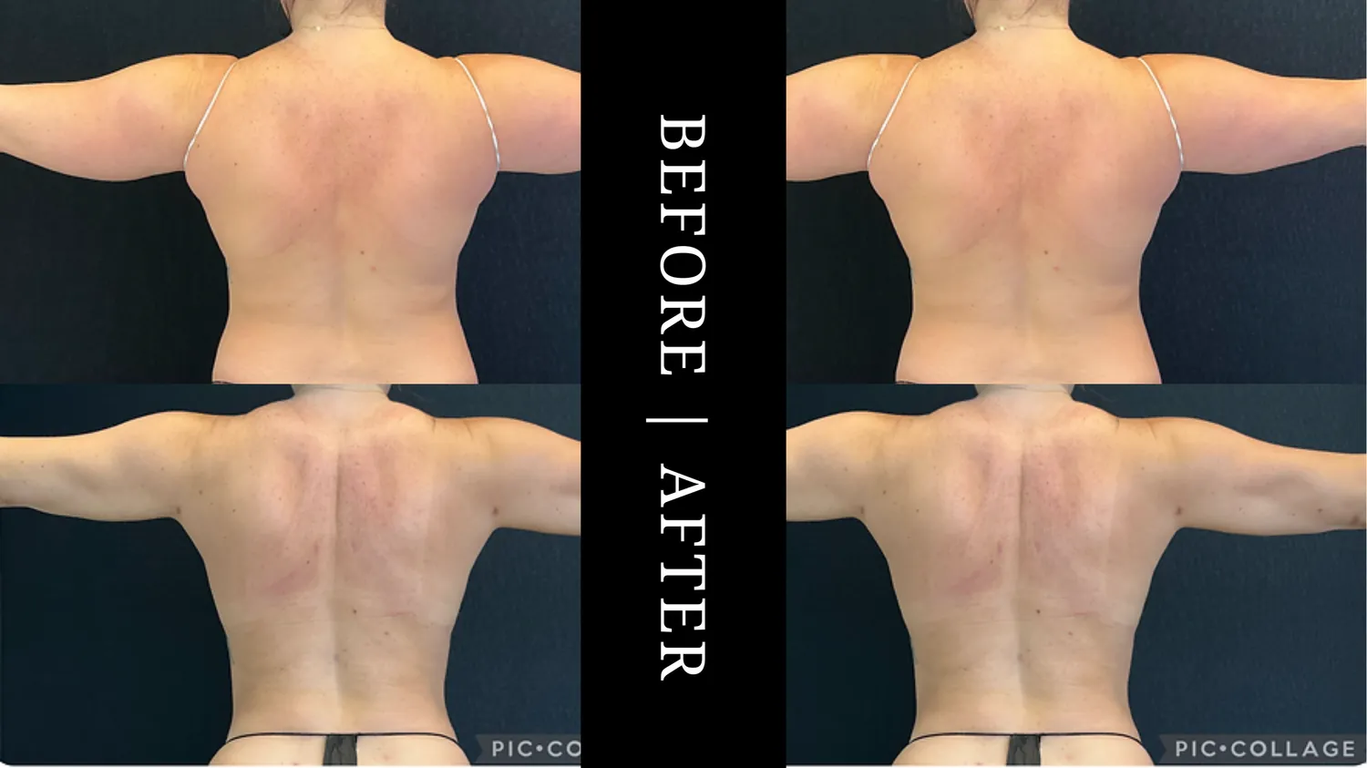 CORE 360 LIPOSUCTION